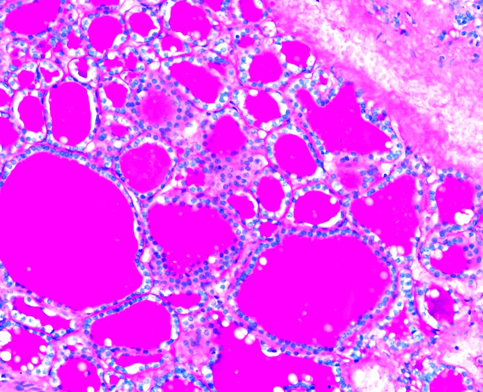 Pathology Outlines Simple Goiter And Nontoxic Multinodular Goiter